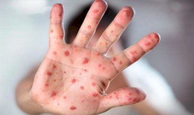 Ahorro en vacunas para sarampión, negligencia presupuestal